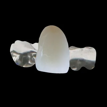 Front Teeth PFM Maryland Bridge